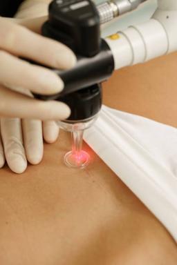 Fractional Laser Treatment in Riyadh for Melasma and Hyperpigmentation