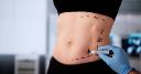 Liposuction in Riyadh for a Slimmer, Toned Look