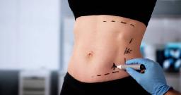 Liposuction in Riyadh for a Slimmer, Toned Look
