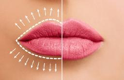 Lip Filler for Asymmetry Correction in Riyadh