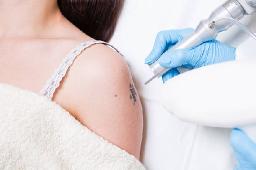 Laser Tattoo Removal Strategies for Addressing Unwanted Ink Safely
