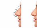 Best Clinics for Hiko Nose Lift in Riyadh and Their Prices