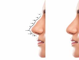 Best Clinics for Hiko Nose Lift in Riyadh and Their Prices