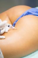 Sculptra Injections for Buttocks: Price Range in Riyadh
