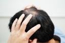 How PRP Hair Treatment Complements Modern Hair Restoration Approaches