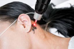 Laser Tattoo Removal for Addressing Tattoos With Uneven Fading
