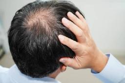 Hair Loss Treatment Solutions for Common Hair Density and Growth Issues
