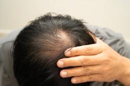 Can PRP Hair Treatment Improve Hair Thickness?