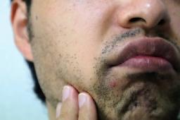 Are Smoker&rsquo;s Lips Treatments Safe?
