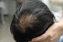 How Many Hair Loss Treatment Sessions May Be Needed?