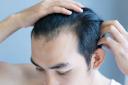 PRP Hair Treatment in Riyadh for Improving Scalp Health