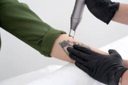Aftercare Tips for Laser Tattoo Removal in Riyadh