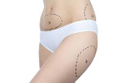 Liposuction Procedure Preparation for a More Comfortable Recovery