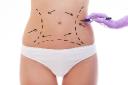 Liposuction in Riyadh: A Complete Guide to Body Contouring