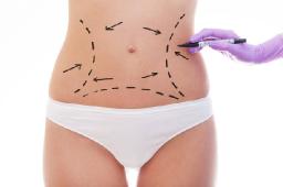 Liposuction in Riyadh: A Complete Guide to Body Contouring
