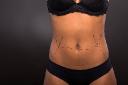 Can Liposuction Improve Your Waistline?