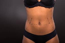 Can Liposuction Improve Your Waistline?