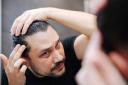How Soon Can You Return to Work After PRP Hair Treatment?