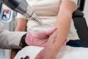 Laser Tattoo Removal in Riyadh for Multicolored Tattoos