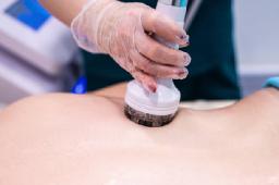 Venus Legacy for Non-Invasive Facial Skin Tightening