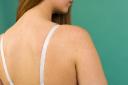  Back Acne Treatment Tips for a Clearer Body Complexion