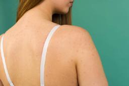  Back Acne Treatment Tips for a Clearer Body Complexion