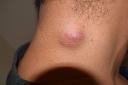 Comparing Sebaceous Cyst Removal Prices in Riyadh