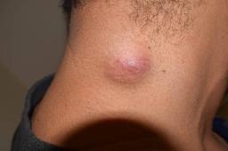 Comparing Sebaceous Cyst Removal Prices in Riyadh