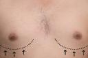 Gynecomastia Surgery in Riyadh: Questions to Ask