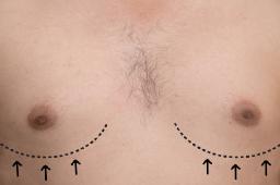 Gynecomastia Surgery in Riyadh: Questions to Ask