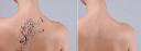 Laser Tattoo Removal Services Available in Riyadh