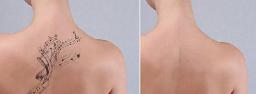 Laser Tattoo Removal Services Available in Riyadh