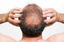 How Does PRP Hair Treatment Stimulate Hair Growth?