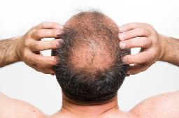 How Does PRP Hair Treatment Stimulate Hair Growth?