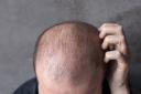 Early Signs of Hair Loss You Should Not Ignore