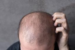 Early Signs of Hair Loss You Should Not Ignore
