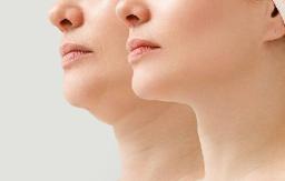 Double Chin Liposuction in Riyadh: Discover Modern Chin Sculpting Options