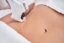 Laser Scar Removal for Smoother-Looking and Refined Skin