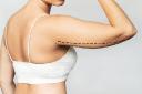 Liposuction in Riyadh: Understanding Recovery and Expected Outcomes