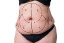 How Tummy Tuck Surgery Addresses Stubborn Skin Below the Waistline