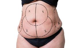 How Tummy Tuck Surgery Addresses Stubborn Skin Below the Waistline