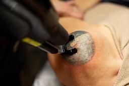 What to Expect During Your First Session of Laser Tattoo Removal in Riyadh