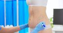 Questions to Ask at a Liposuction Consultation