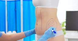 Questions to Ask at a Liposuction Consultation