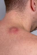 Does Cyst Size Affect Removal Cost?