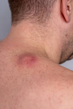 Does Cyst Size Affect Removal Cost?