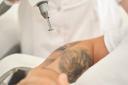 Does Tattoo Color Affect Laser Removal?