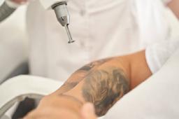 Does Tattoo Color Affect Laser Removal?