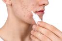 Acne Treatment Options: A Complete Overview