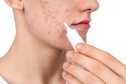 Acne Treatment Options: A Complete Overview